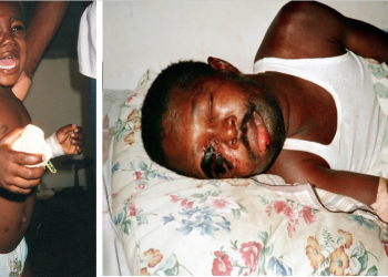 30 cas de charbons cutanés découverts dans la Grand’Anse, la rumeur est fondée !